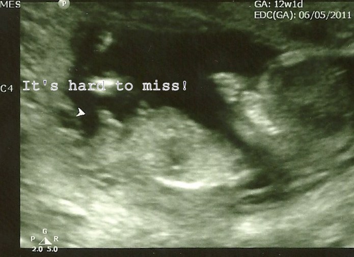 Ultrasound 13 weeks Boy Parts