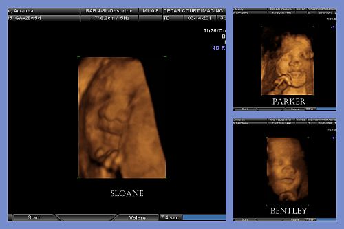 4D Ultrasound Comparison