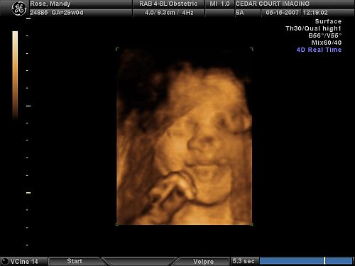 4D Ultrasound Comparison