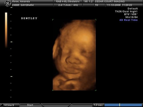 4D Ultrasound Comparison