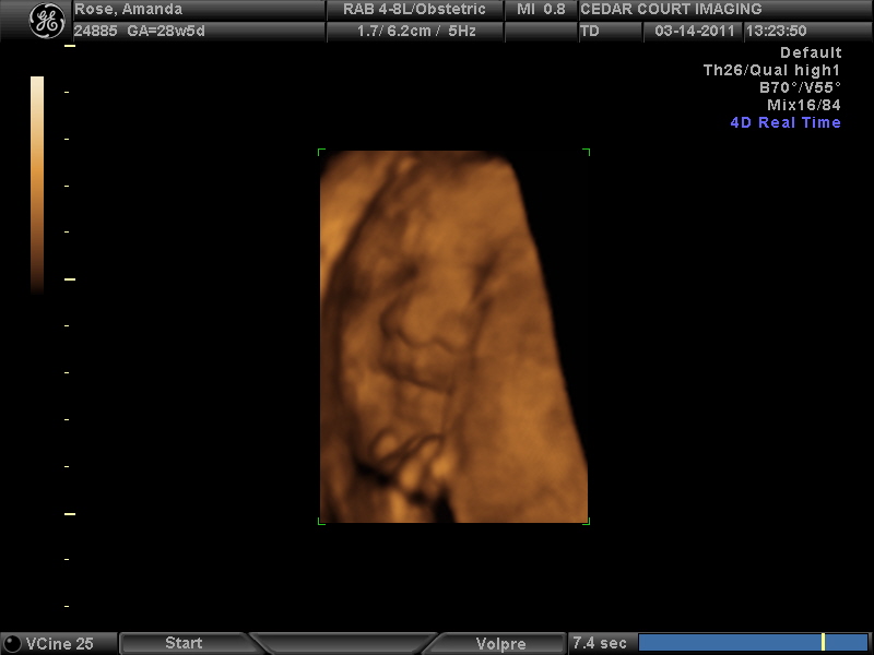 4D Ultrasound Comparison