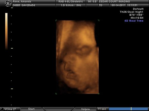 4D Ultrasound Comparison