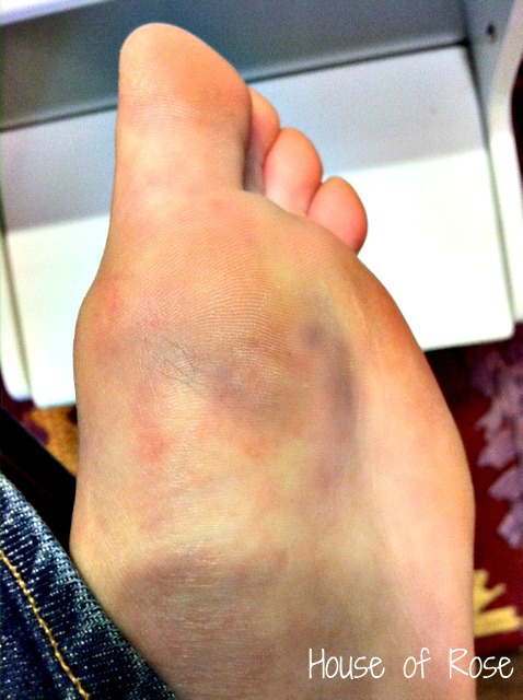 bruised bottom of foot