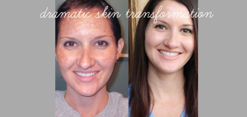 Obagi Skin Transformation Dramatic